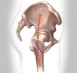 Minimally Invasive Hip Replacement