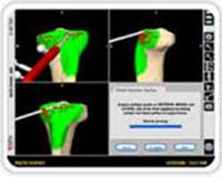 computer-assisted-joint-replacement-clip2