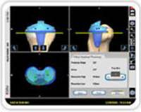 computer-assisted-joint-replacement-clip3