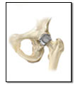 hip resurfacingimplant